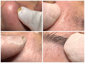 サラグランデ(Sara Grande)/毛穴の中からこんなに!