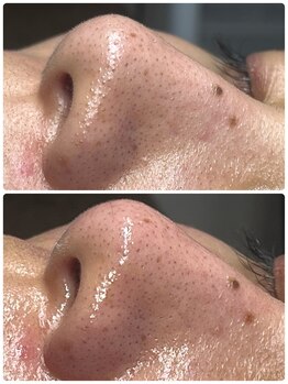 ポマイカイ 名古屋丸の内店(pomaikai)/ハイドロフェイシャル