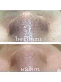 ブレリアントサロン 池袋店(brillant salon)/【30代女性】毛穴洗浄