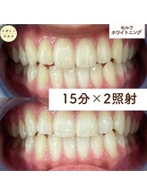 メガミノチカラ/セルフホワイトニング