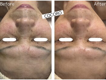 ココロ(COCORO)/シワ集中改善★