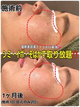 リズベット(LIZ BET)/大人気シミケア！３０分枠★