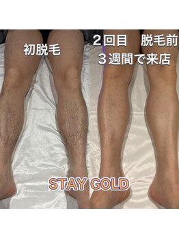 ステイゴールド 新百合ヶ丘(STAY GOLD)/足脱毛!ツルツルが流行ります!