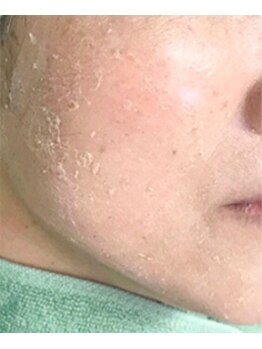 マリー エクラン/ハーブピーリング