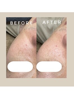 カウニス るる(kaunis)/【ララピール】Before After