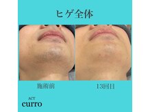 アクト クロ(ACT curro)/【ヒゲ全体】脱毛施術例