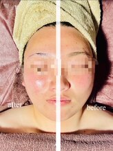 ラクラク(rakuraku)/リフトアップフェイシャル【女】