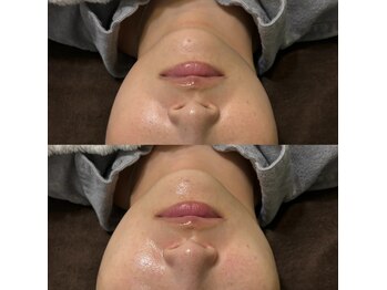 ミヨン(Miyong)/フェイスラインをシャープに