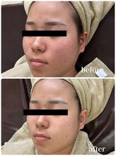 ジャスミン(Jasmin)/オーダーメイド高濃度原液導入