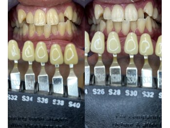 トウキョウスワーズ 池袋店(TOKYO SWRS)/#ホワイトニング #池袋 #渋谷