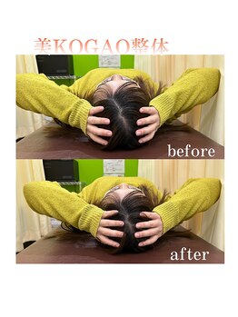 東灘区甲南山手わだち整骨院/美小顔矯正ビフォーアフター