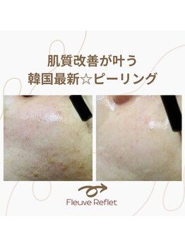 フルーヴ ルフレ(Fleuve Reflet)/劇的！before/after 肌革命☆