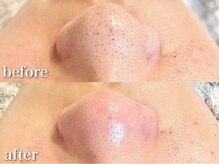 毛穴の黒ずみを一つ一つ狙い撃ち!1回目でこの変化に驚く方多数!