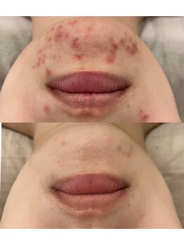 ニコリー(NICOLY)/赤ニキビケア症例【施術5回目】