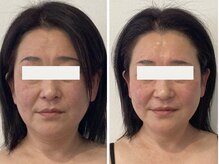 50代フェイスラインたるみ改善／ほうれい線／マリオネットライン