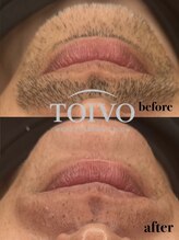 トイヴォ(TOIVO)/顔脱毛ビフォーアフター！