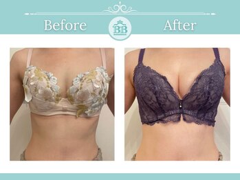 美人バスト アンド ヒップアップ 広島店/バストアップ症例写真