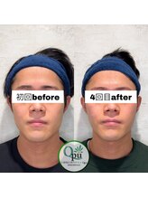 キュープ 相模原淵野辺店(Qpu)/たった4回で人生で1番小さな顔に