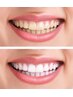 ☆白い歯は美人の条件！思いっきり笑顔になろうセルフホワイトニング¥4300☆