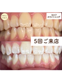 メガミノチカラ/セルフホワイトニング