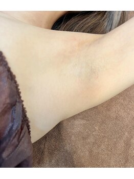 リリ(RiRi)/【脱毛】美肌脱毛