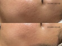 レイル(REIR)/メニュー：純粋レチノールピール