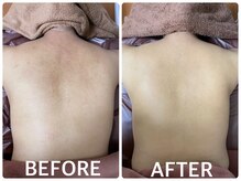 ハーブピーリング 恵比寿/色素くすみ沈着/トーンアップ