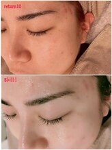 サロンドットブレスドットケイ(salon.bless.k)/マイクロニードル3回目