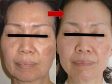 ブリリアン デイスパ 阪急西宮ガーデンズ店(BRILLIAN DAYSPA)/水光ピーリング