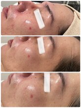 ピーナップ(P-nap)/ニキビ・毛穴改善