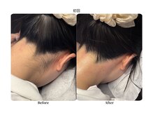 チョクチョクサロン(CHOKCHOK. Salon)/うなじMIX脱毛