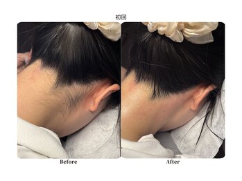 チョクチョクサロン(CHOKCHOK. Salon)/うなじMIX脱毛