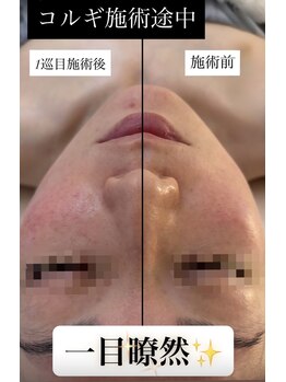 コンジュ(kongju)/コルギ施術途中 左右比較写真☆