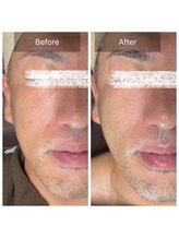 ラビ(RABBI)/40代男性小顔矯正