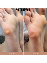 マオヌー(MAONU)/韓国式足裏角質ケア　症例写真