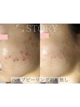 ストーリー(STORY)&nbsp;ハーブ ピーリング