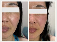 恵比寿脱毛 シーズ(She’s)/ソフトダーマ40代ビフォア