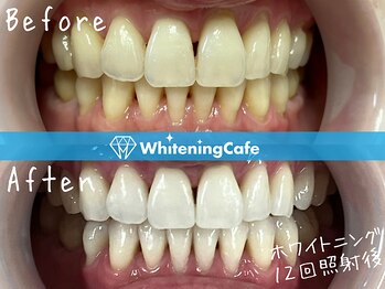 ホワイトニングカフェ 松本店(WhiteningCafe)/ホワイトニングビフォーアフター