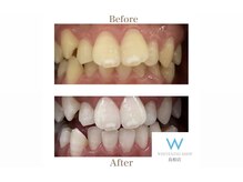 ホワイトニングショップ 島根店/Before&After美白ホワイトニング