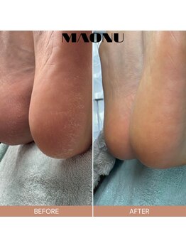 マオヌー(MAONU)/韓国式足裏角質ケア　症例写真