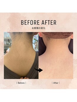 ルミエールブランシュ(Lumiere blanche)/全身脱毛