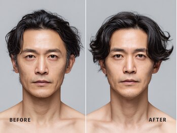 ミネルバ(MINERVA)/施術例 40代男性 フェイシャル