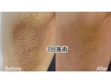 アカヌケ(AKANUKE)/ワキ脱毛