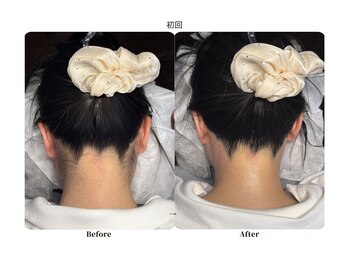 チョクチョクサロン(CHOKCHOK. Salon)/うなじMIX脱毛