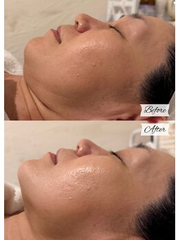 エステサロン アンジュール(Angelle)/Before→After
