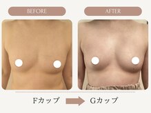 ウェルバスト(Well Bust)/バストアップ例】F→Gカップ