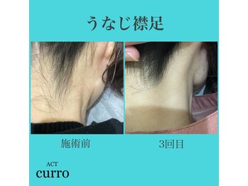 アクト クロ(ACT curro)/【うなじ襟足】脱毛施術例