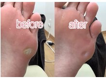 とくしま整体院 藍住院/足のタコでお悩みの方必見！！
