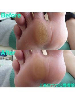 上高田つつじ整体院/角質ケア　施術例