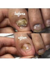 ネイルサロン ユーズ(USE.)/【トラブル爪ケア】フットケア